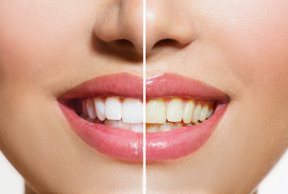 Stained Teeth | Dentist Osmond￼